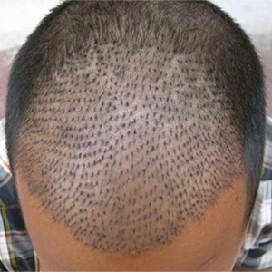 Hair Transplant Cost in Noida, Low Cost Hair Transplant Specialist Doctors  Clinic in Noida